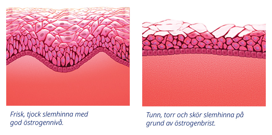 Frisk slemhinna med god östrogennivå och torr slemhinna på grund av östrogenbrist